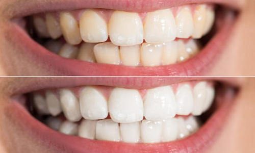 شیوه هایی جهت سفید کردن دندان