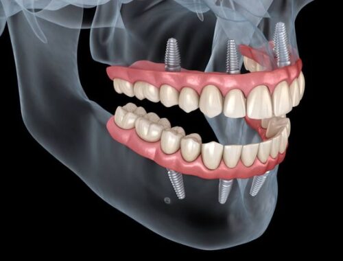 ایمپلنت دندان با جراحی