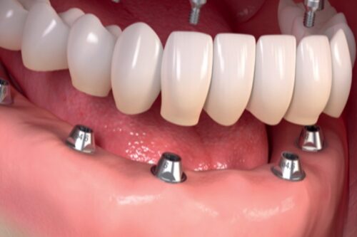 هزینه دست دندان کامل اوردنچر